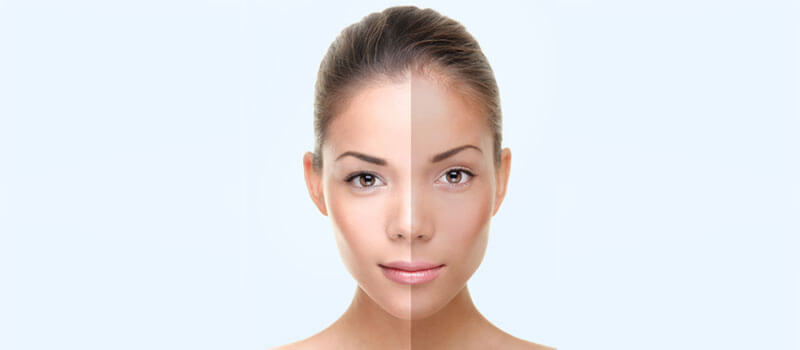 Skin Bleaching