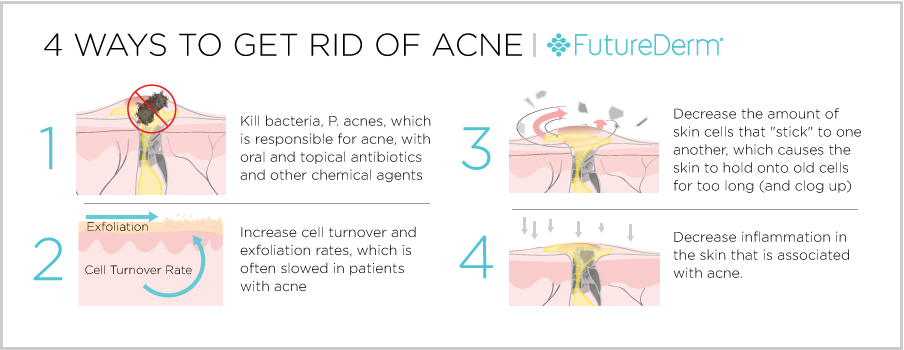 4 Ways to Get Rid of Acne FutureDerm Article